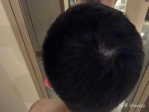 抖音看多了看看是否发旋在扩大
