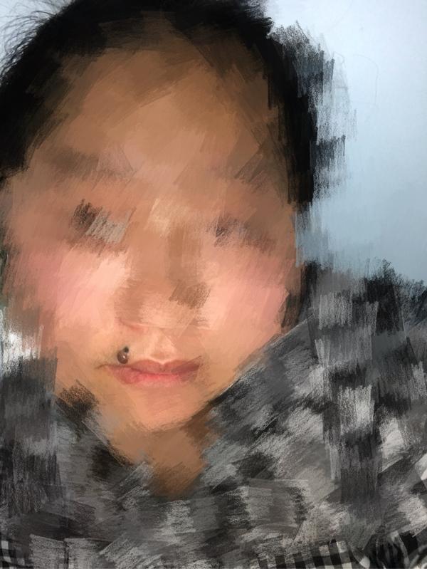 3.16我把嘴唇上两颗痣手术切除了,上面一颗三毫米,下面一颗四毫米,!