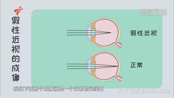 假性近视别当"真",要对眼镜说"no"