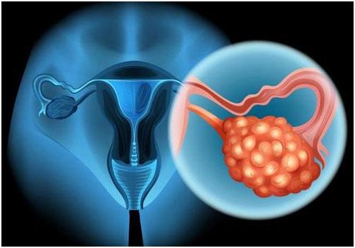 我国每年约有5.2万名女性被确诊为卵巢癌,死亡2.