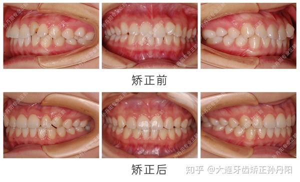 大连舌侧矫正拔除左上门牙与侧切牙间的多生牙矫治牙齿拥挤