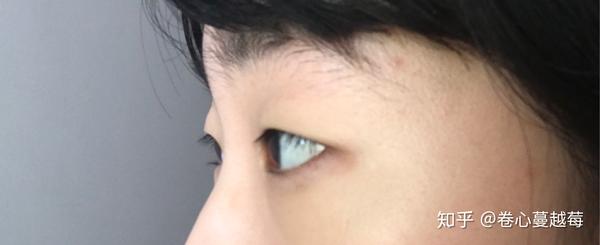 微创/三点式双眼皮恢复记录(含术后三个月微调)