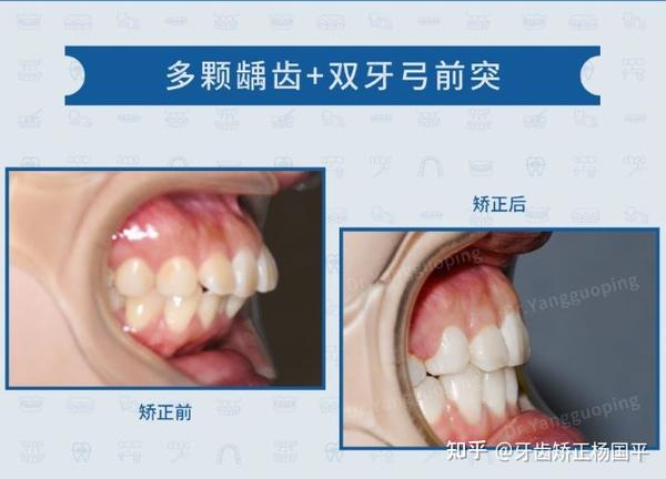 上海牙齿矫正双牙弓前突舌侧矫正如何整治