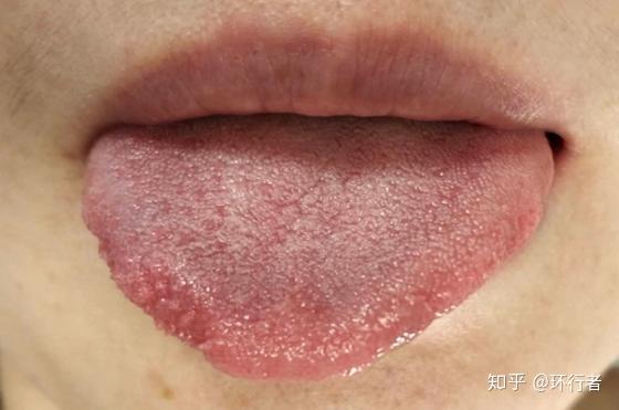 舌头火烧火燎好难受?口腔科医生建议:灼口综合征患者可以这么做