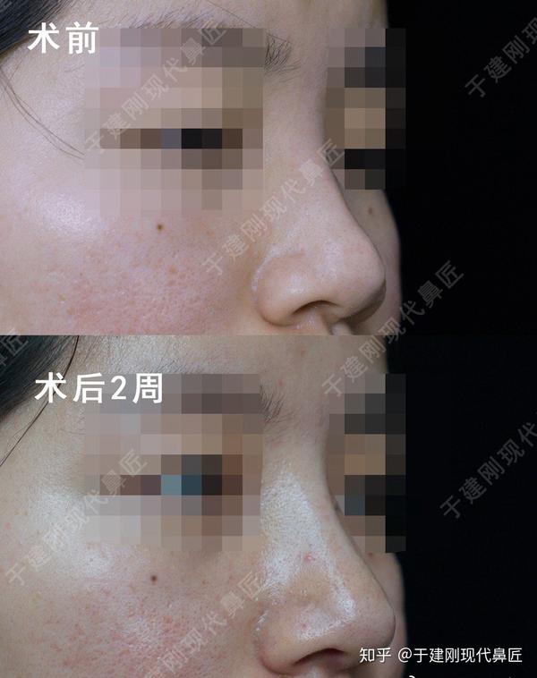 美女术前鼻翼软骨间隔比较大,鼻基底观成盒状,鼻尖没有集中点.