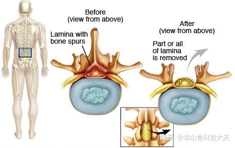 小开窗手术就是椎板开窗髓核摘除术还有椎板开窗髓核摘除术是微创手术