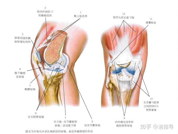图解膝关节软组织挛缩,粘连,瘢痕