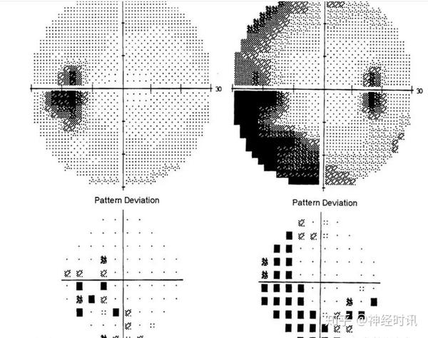 humphrey视野显示右眼除生理盲点扩大外还伴鼻下方弓形视野缺损;左眼