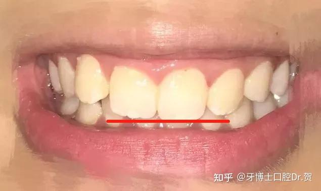 下巴看起来不够立体,容易变成人们所说的"猪腰子脸", "月牙脸",特别