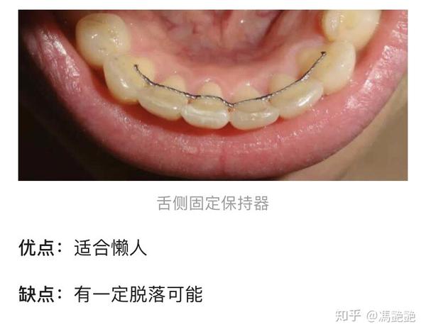 熬过了矫牙期却死在了保持器