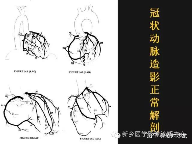 冠状动脉解剖精细到每一个分支