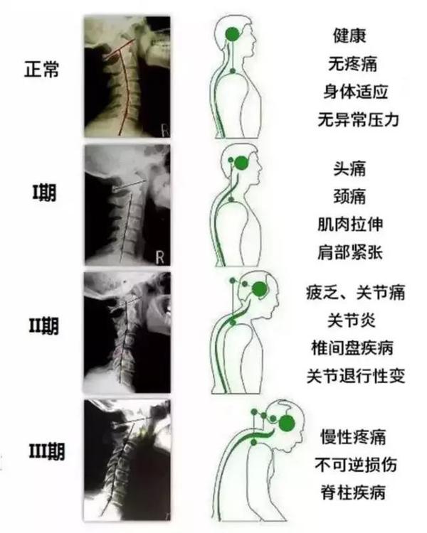 脖子前倾怎么矫正?