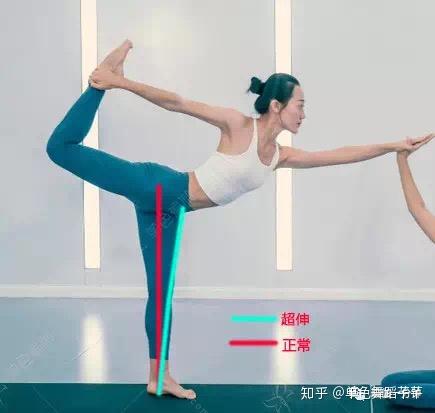 膝盖超伸