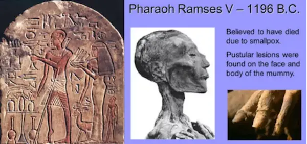 一例天花病毒的案例,竟是3000多年前的埃及法老拉美西斯五世(pharaoh