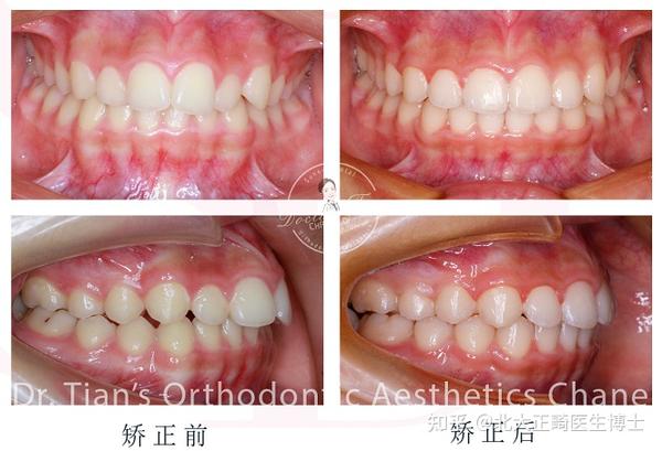 深覆合露龈笑牙齿矫正