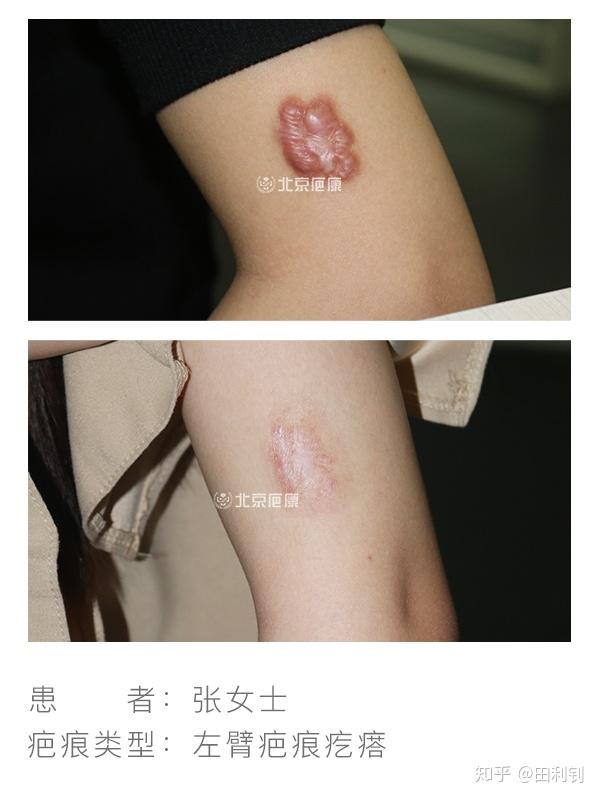 瘢痕疙瘩有哪些治疗方法