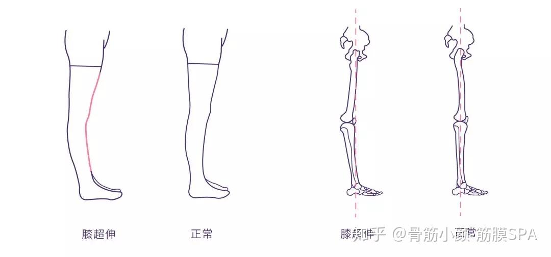 膝超伸又叫膝反弓,是指膝关节伸展幅度过大.