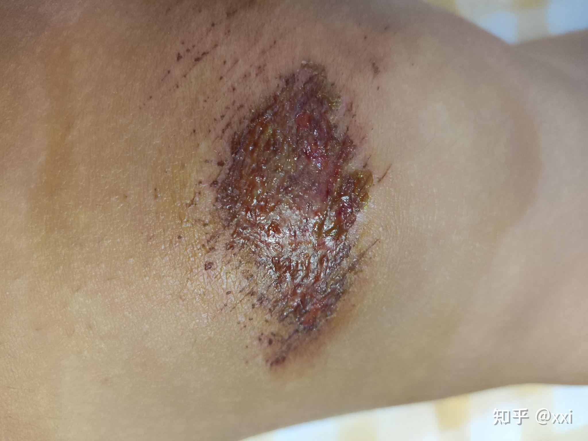 骑电动车摔伤了膝盖第四天了涂红霉素软膏还是阿莫西林的药粉哪个结疤