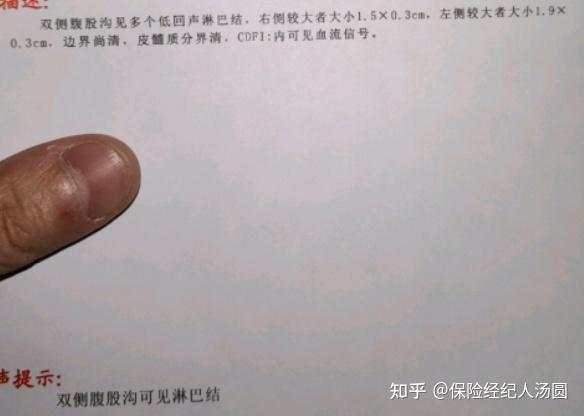 腹股沟淋巴结肿大的检查报告
