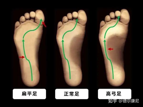 高弓足的症状和危害有哪些?