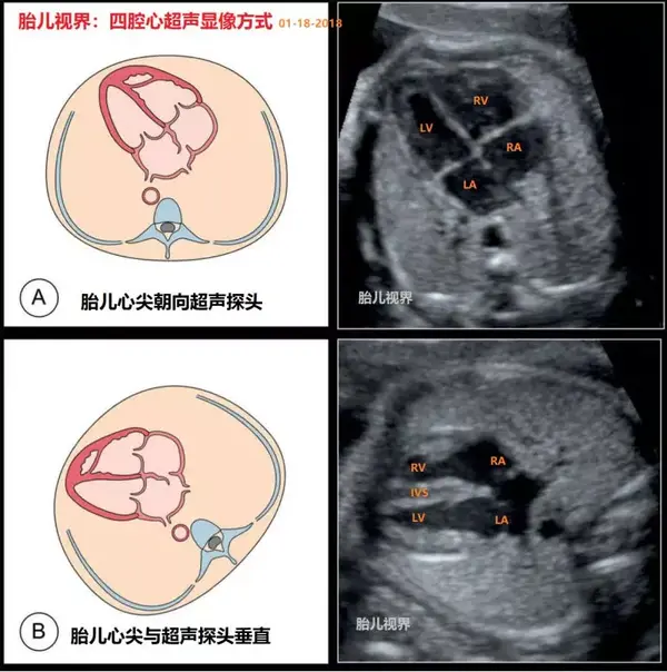 胎儿心脏及血液循环解剖特点