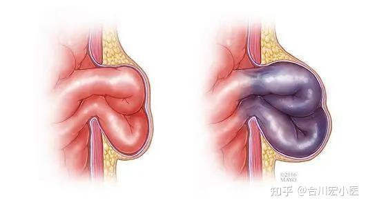                     腹股沟疝的