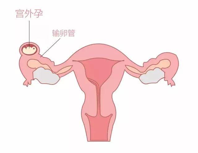宫外孕