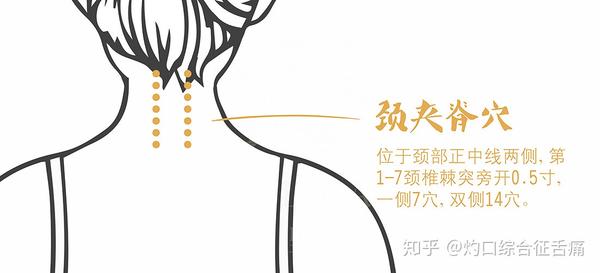 主要分三步:  颈肩部位,主要灸透3个穴位:肩井,颈夹脊,大椎.