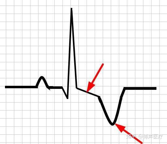 博声医疗:st段改变,st段改变是什么意思?