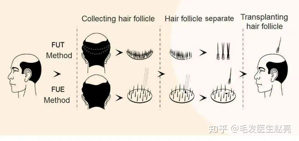 雄激素性脱发 zhuanlan.zhihu.com