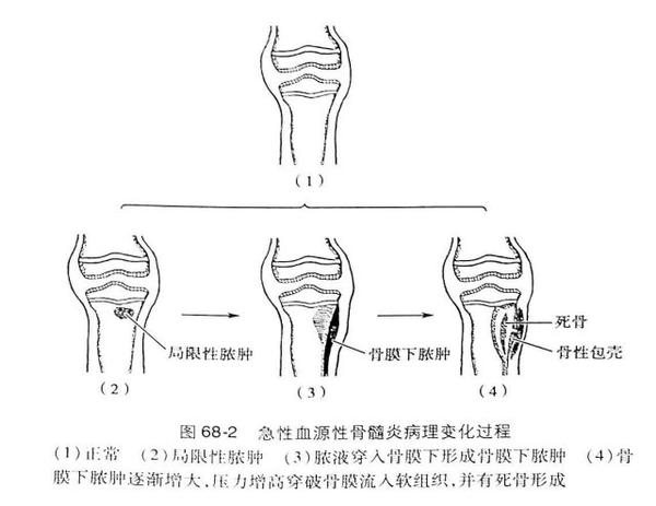 骨与关节化脓性感染笔记