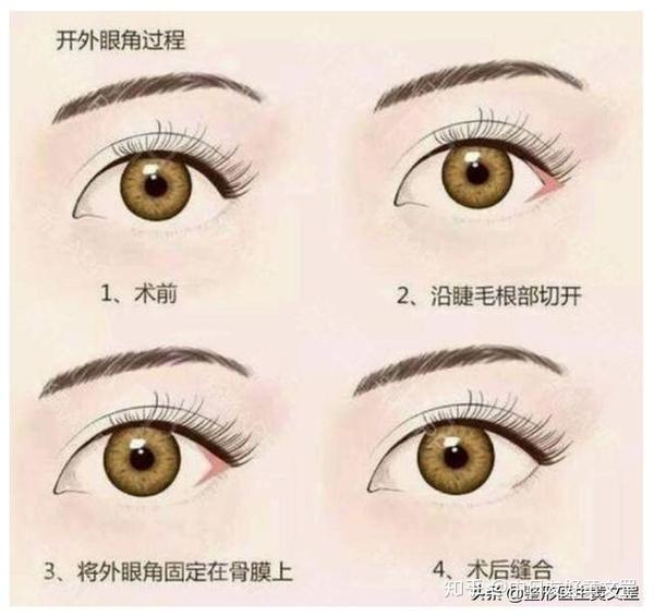 眼综合手术科普眼综合割双眼皮ta包含这8个项目