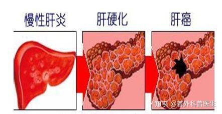 肝癌的临床表现