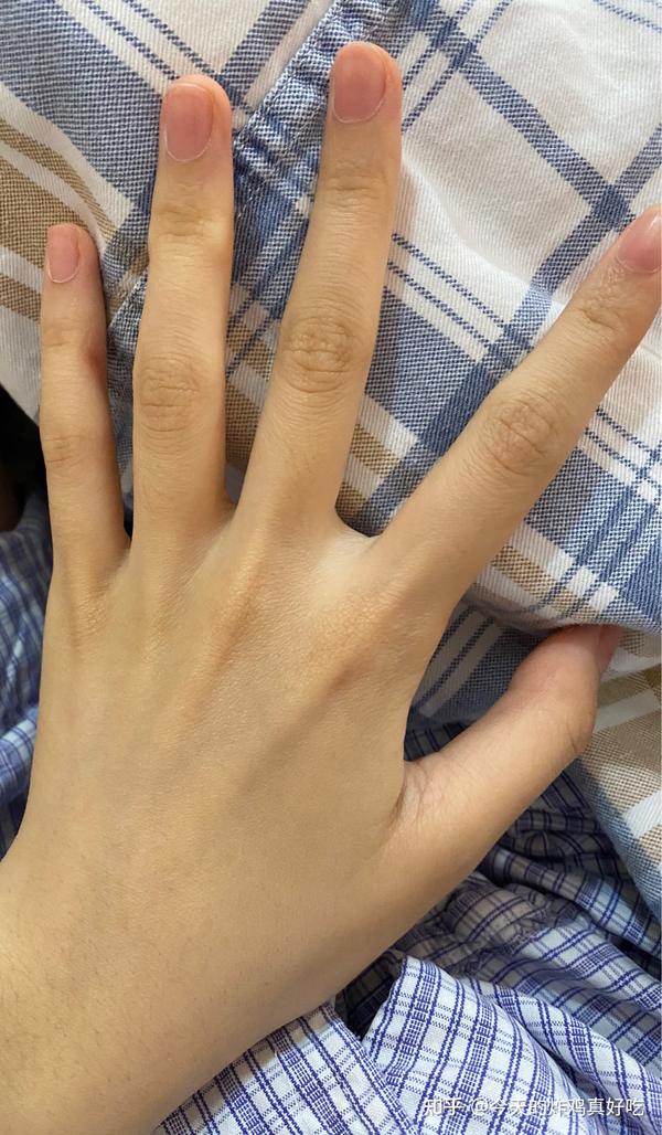 左手和右手对比,打滞留针的那只手明显肿了许多.