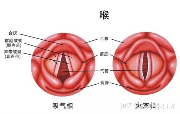 声带白斑是指声带粘膜表面有灰白色角化斑块,是声带粘膜鳞形上皮过度