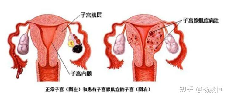 女性之痛子宫腺肌症