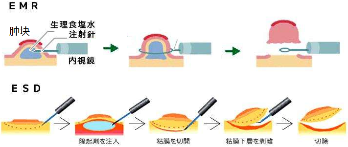 内镜黏膜下剥离术esd常见问题上