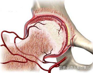 股骨头坏死早期症状,你发现了吗? 1,疼痛 区域:髋部,腹股沟或