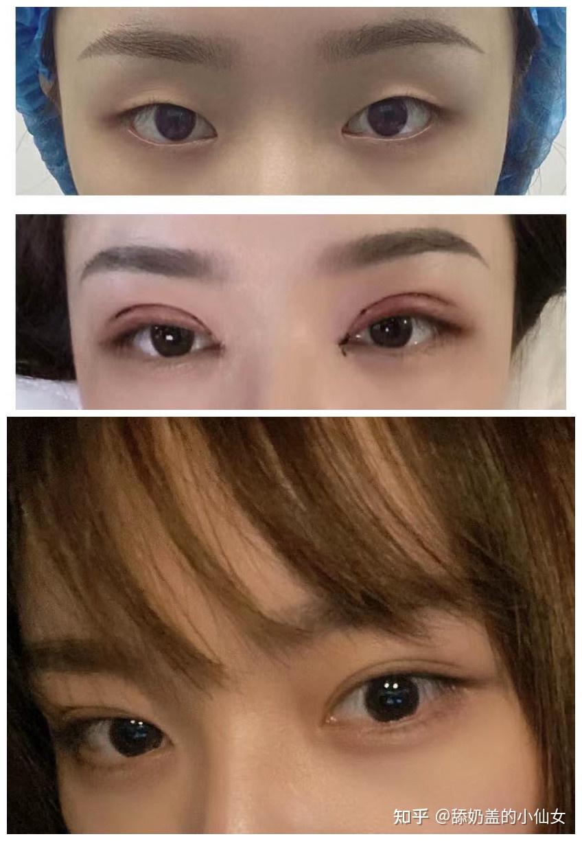 吊眼割什么形状的双眼皮比较好