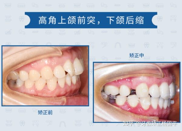 【上海牙齿矫正】上颌前突,下颌后缩,舌侧正畸中的效果如何?