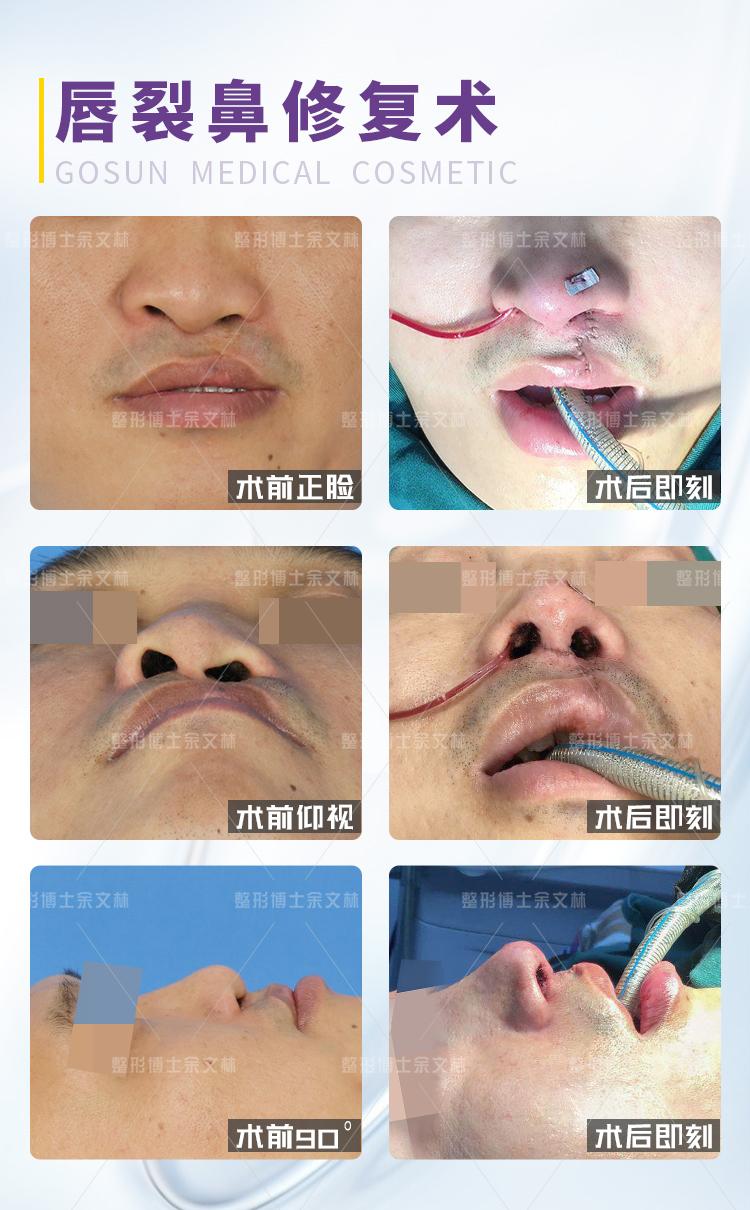 余文林解疑:唇裂修复术后唇部伤口会裂开吗?