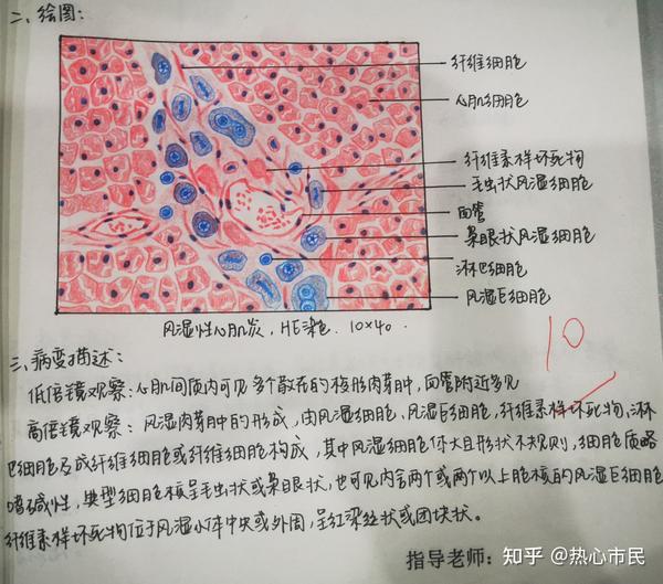 病理学红蓝铅笔手绘图实验报告病变描述