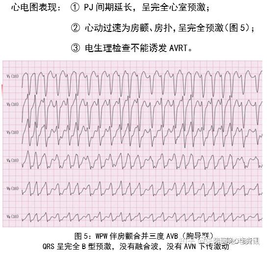 预激综合征心电图少见表现与诊断思路