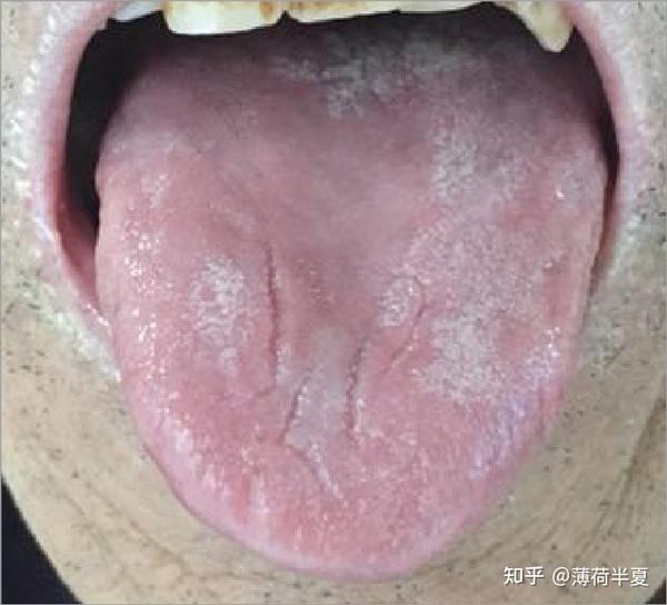 裂纹舌(3)