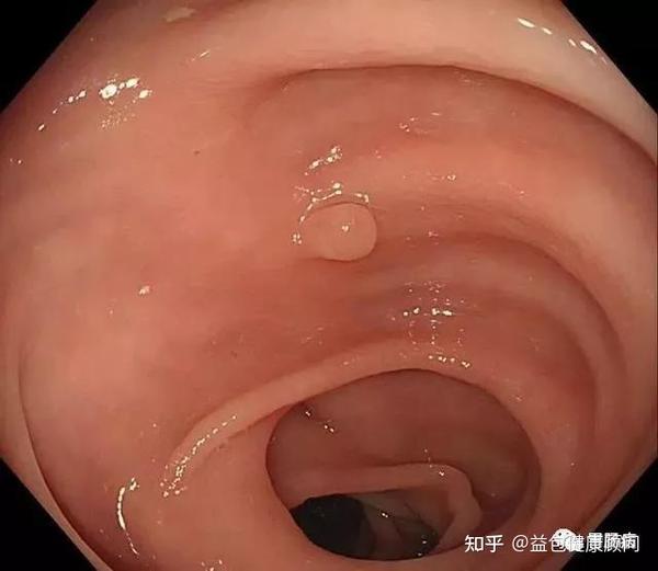 全面解读——结直肠息肉