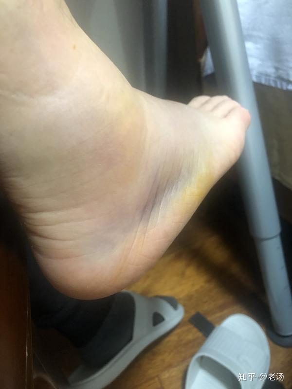 右脚崴脚(有骨折)的健身之路
