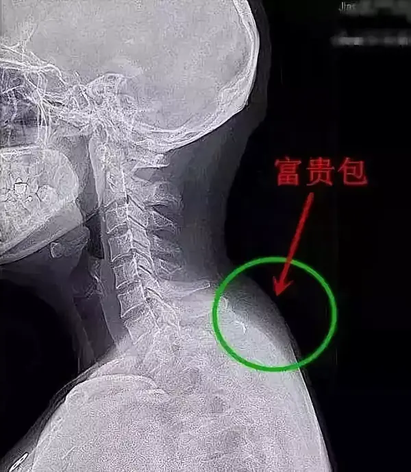 从解剖学的角度来讲, 富贵包指的是在后背上部颈胸交界处,即在第七