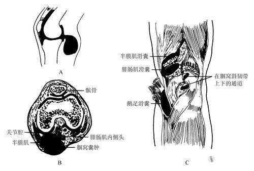 李大爷总是小腿疼痛,腿弯子处还有一个大肿块,到底是怎么了?