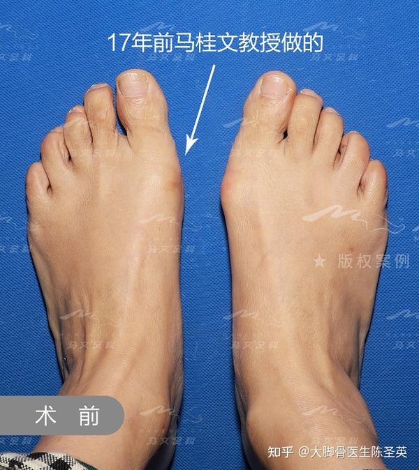 因大脚骨(拇外翻)问题17年后再相聚