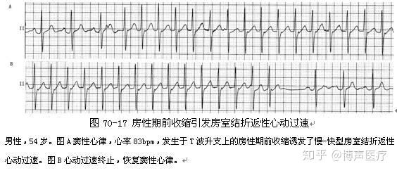 约50%的房内折返性心动过速患者有器质性心脏病. 3.